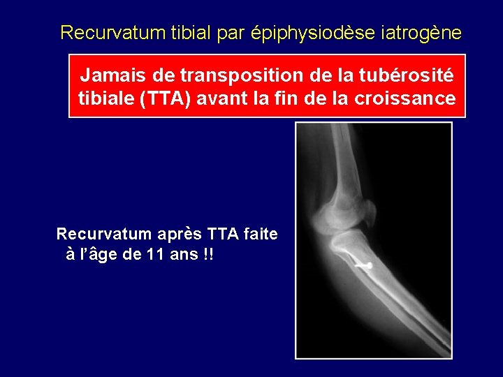 Recurvatum tibial par épiphysiodèse iatrogène Jamais de transposition de la tubérosité tibiale (TTA) avant