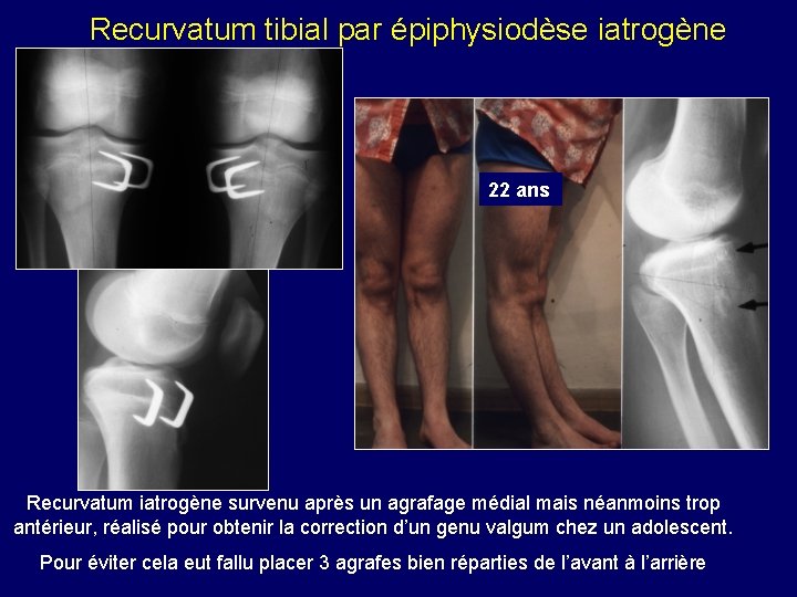 Recurvatum tibial par épiphysiodèse iatrogène 22 ans Recurvatum iatrogène survenu après un agrafage médial