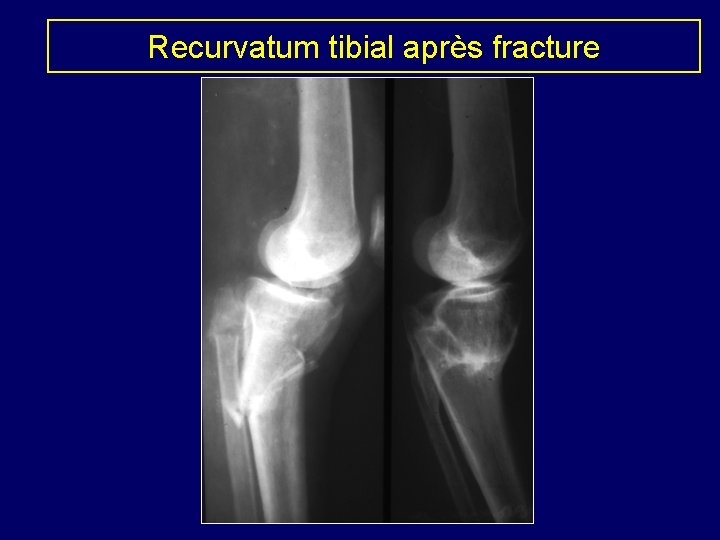 Recurvatum tibial après fracture 