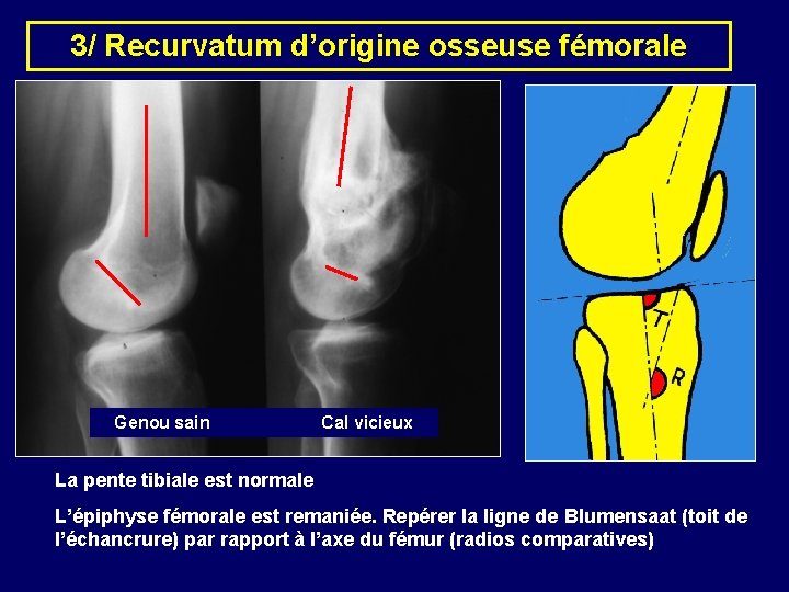 3/ Recurvatum d’origine osseuse fémorale Genou sain Cal vicieux La pente tibiale est normale