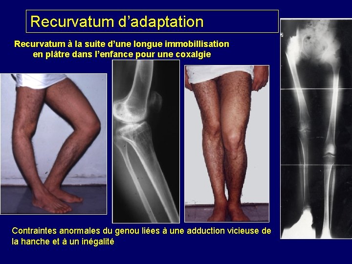 Recurvatum d’adaptation Recurvatum à la suite d’une longue immobillisation en plâtre dans l’enfance pour Recurvatum d’adaptation Recurvatum à la suite d’une longue immobillisation en plâtre dans l’enfance pour