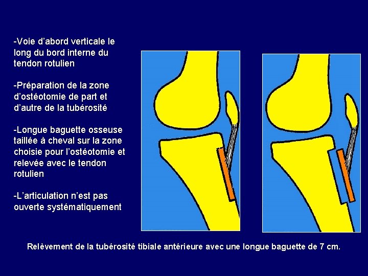 -Voie d’abord verticale le long du bord interne du tendon rotulien -Préparation de la -Voie d’abord verticale le long du bord interne du tendon rotulien -Préparation de la