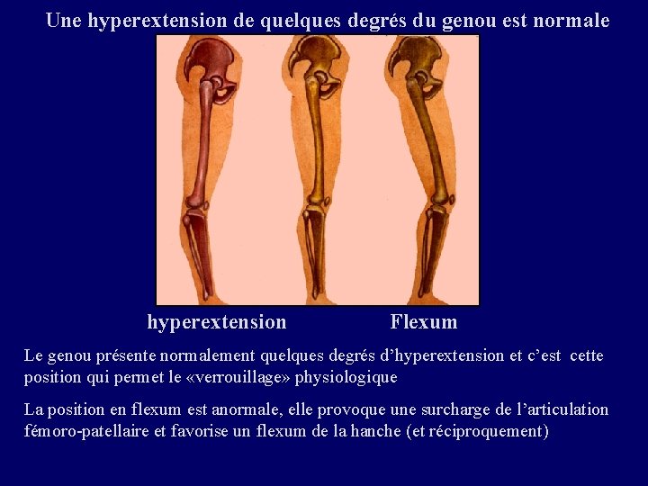Une hyperextension de quelques degrés du genou est normale hyperextension Flexum Le genou présente Une hyperextension de quelques degrés du genou est normale hyperextension Flexum Le genou présente