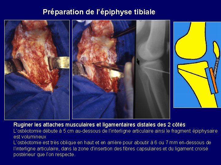 Préparation de l’épiphyse tibiale Ruginer les attaches musculaires et ligamentaires distales des 2 côtés