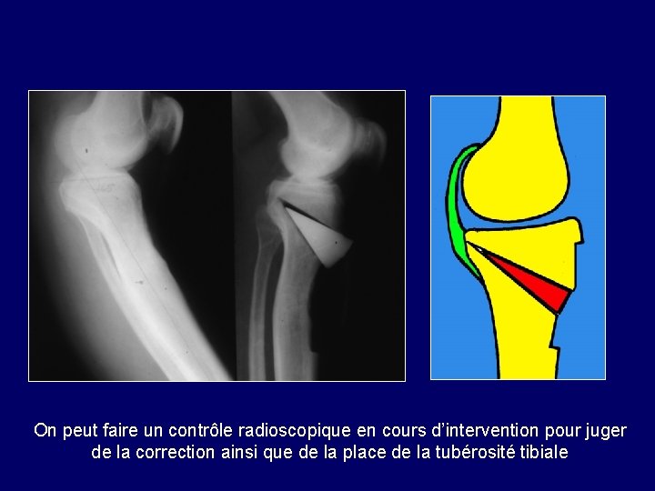  On peut faire un contrôle radioscopique en cours d’intervention pour juger de la