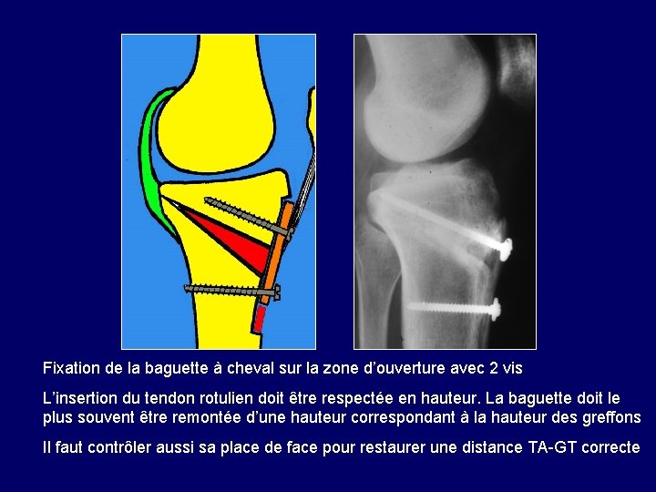 Fixation de la baguette à cheval sur la zone d’ouverture avec 2 vis L’insertion Fixation de la baguette à cheval sur la zone d’ouverture avec 2 vis L’insertion
