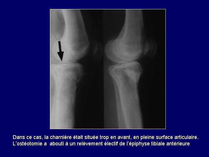 Dans ce cas, la charnière était située trop en avant, en pleine surface articulaire. Dans ce cas, la charnière était située trop en avant, en pleine surface articulaire.