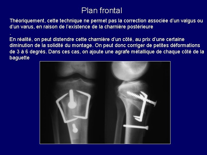 Plan frontal Théoriquement, cette technique ne permet pas la correction associée d’un valgus ou