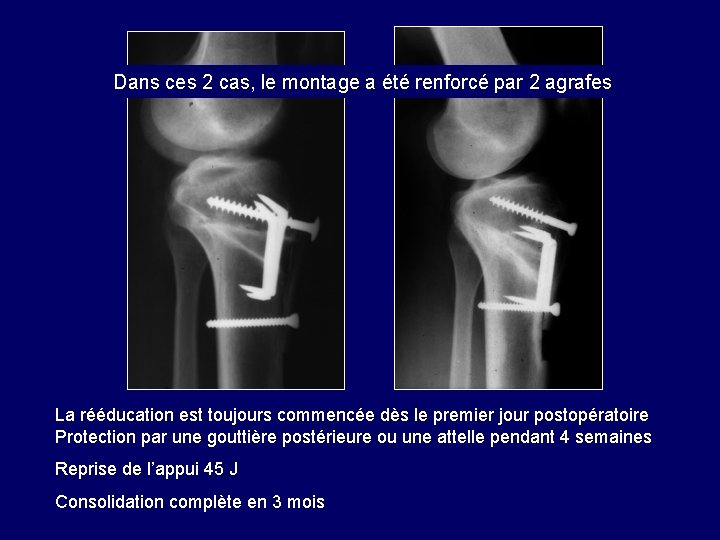 Dans ces 2 cas, le montage a été renforcé par 2 agrafes La rééducation Dans ces 2 cas, le montage a été renforcé par 2 agrafes La rééducation
