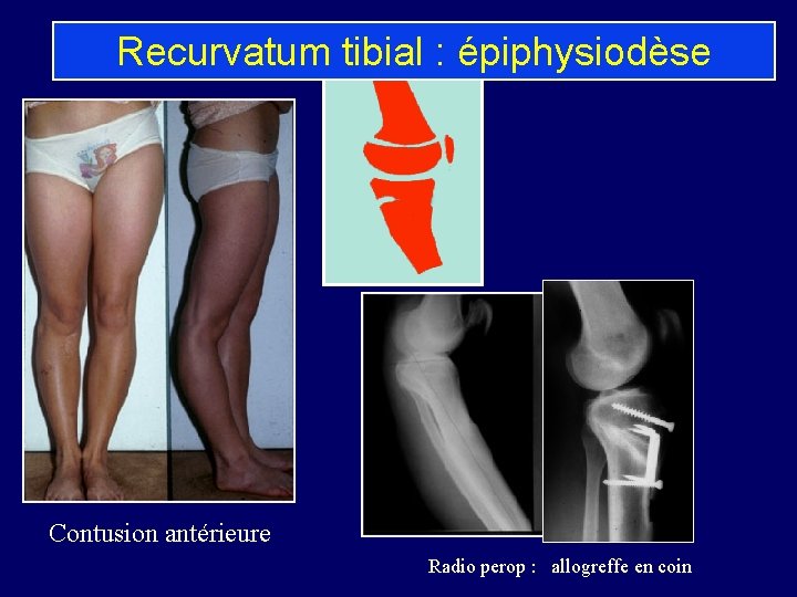 Recurvatum tibial : épiphysiodèse Contusion antérieure Radio perop : allogreffe en coin 