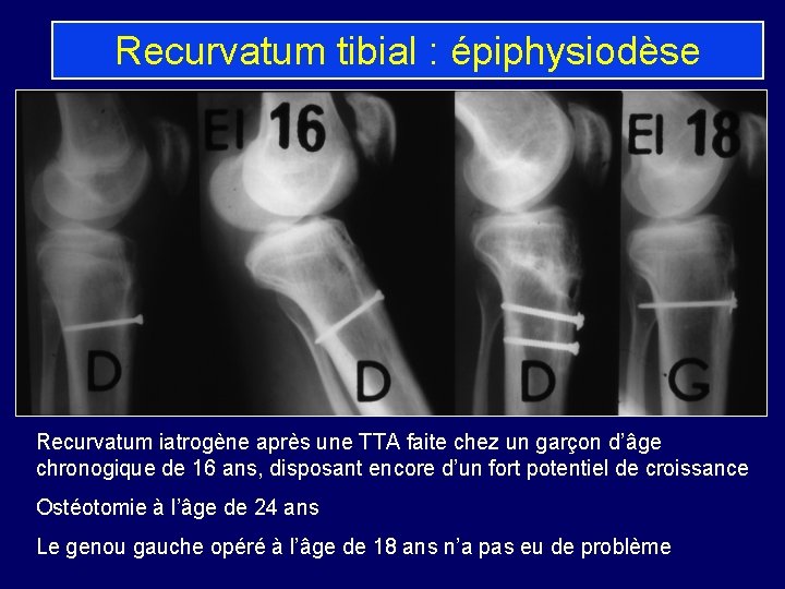 Recurvatum tibial : épiphysiodèse Recurvatum iatrogène après une TTA faite chez un garçon d’âge