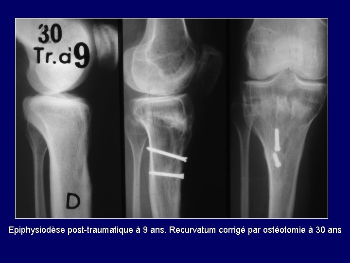 Epiphysiodèse post-traumatique à 9 ans. Recurvatum corrigé par ostéotomie à 30 ans 