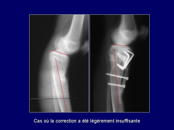 Cas où la correction a été légèrement insuffisante 