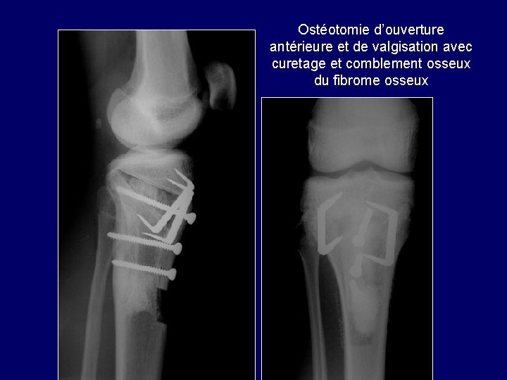 Ostéotomie d’ouverture antérieure et de valgisation avec curetage et comblement osseux du fibrome osseux