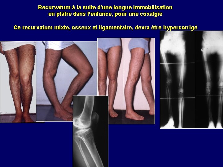 Recurvatum à la suite d’une longue immobilisation en plâtre dans l’enfance, pour une coxalgie