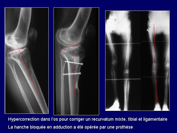 Hypercorrection dans l’os pour corriger un recurvatum mixte, tibial et ligamentaire La hanche bloquée Hypercorrection dans l’os pour corriger un recurvatum mixte, tibial et ligamentaire La hanche bloquée