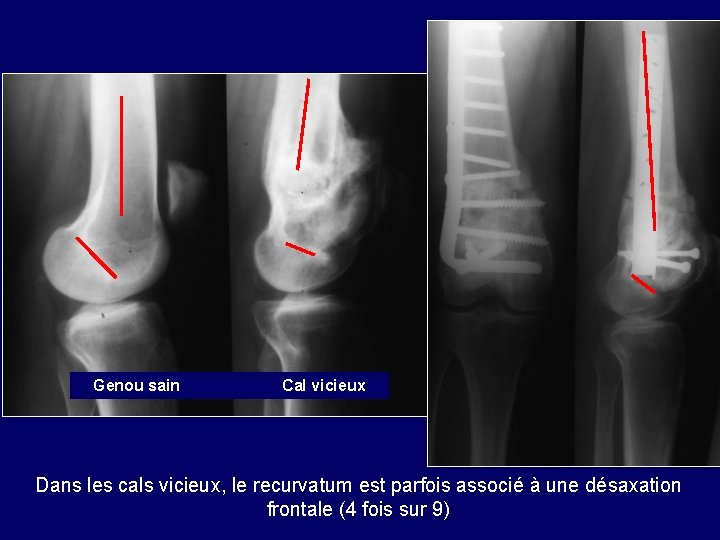 Genou sain Cal vicieux Dans les cals vicieux, le recurvatum est parfois associé à Genou sain Cal vicieux Dans les cals vicieux, le recurvatum est parfois associé à