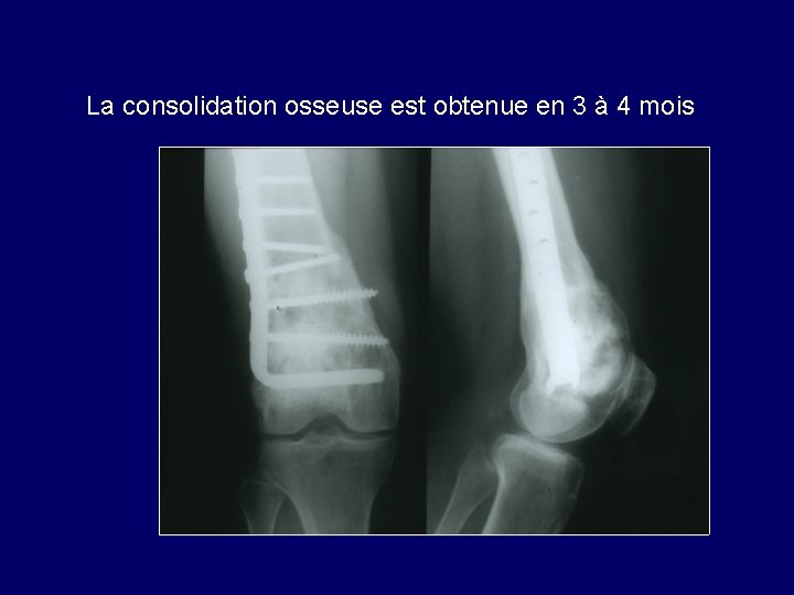 La consolidation osseuse est obtenue en 3 à 4 mois 