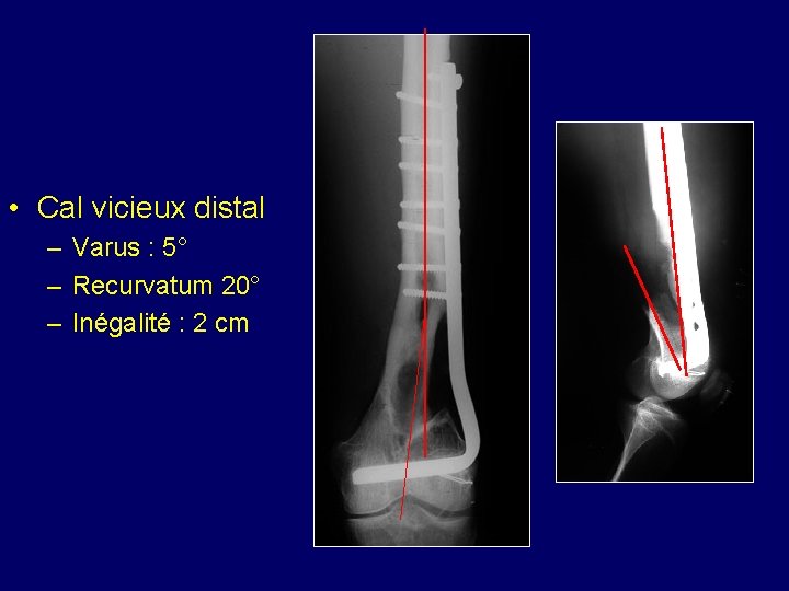 • Cal vicieux distal – Varus : 5° – Recurvatum 20° – Inégalité • Cal vicieux distal – Varus : 5° – Recurvatum 20° – Inégalité