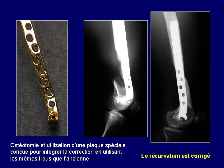 Ostéotomie et utilisation d’une plaque spéciale conçue pour intégrer la correction en utilisant les