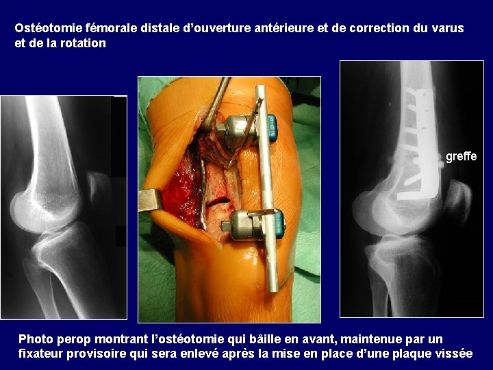 Ostéotomie fémorale distale d’ouverture antérieure et de correction du varus et de la rotation