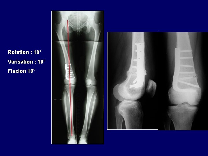  Rotation : 10° Varisation : 10° Flexion 10° 