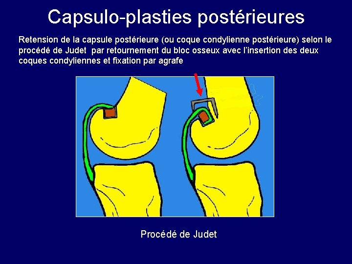 Capsulo-plasties postérieures Retension de la capsule postérieure (ou coque condylienne postérieure) selon le procédé Capsulo-plasties postérieures Retension de la capsule postérieure (ou coque condylienne postérieure) selon le procédé