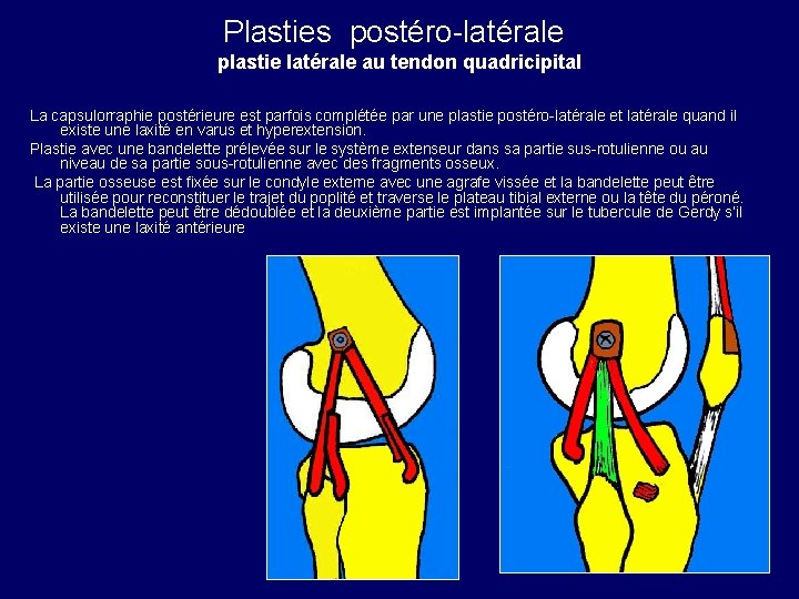 Plasties postéro-latérale plastie latérale au tendon quadricipital La capsulorraphie postérieure est parfois complétée par