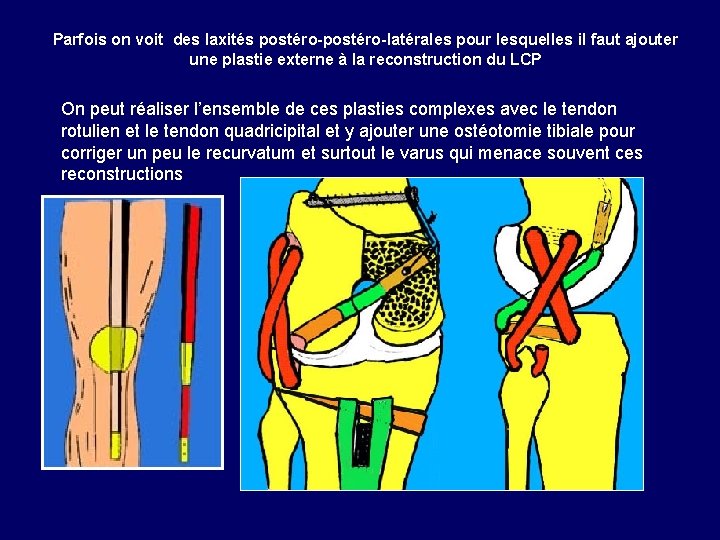 Parfois on voit des laxités postéro-latérales pour lesquelles il faut ajouter une plastie externe Parfois on voit des laxités postéro-latérales pour lesquelles il faut ajouter une plastie externe