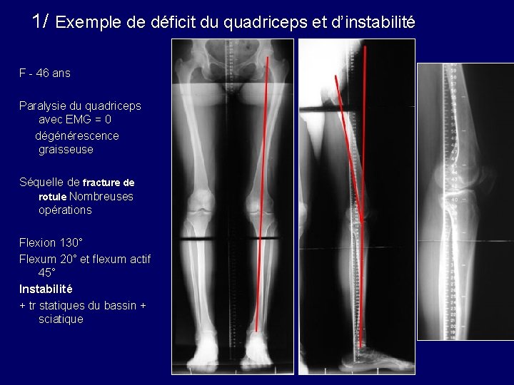 1/ Exemple de déficit du quadriceps et d’instabilité F - 46 ans Paralysie du