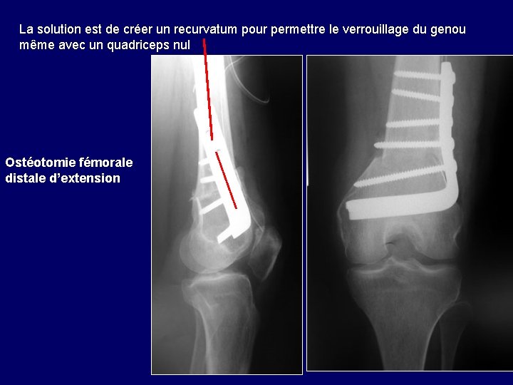 La solution est de créer un recurvatum pour permettre le verrouillage du genou même