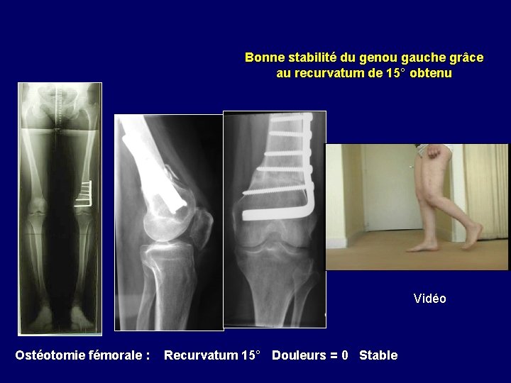 Bonne stabilité du genou gauche grâce au recurvatum de 15° obtenu Vidéo Ostéotomie fémorale Bonne stabilité du genou gauche grâce au recurvatum de 15° obtenu Vidéo Ostéotomie fémorale