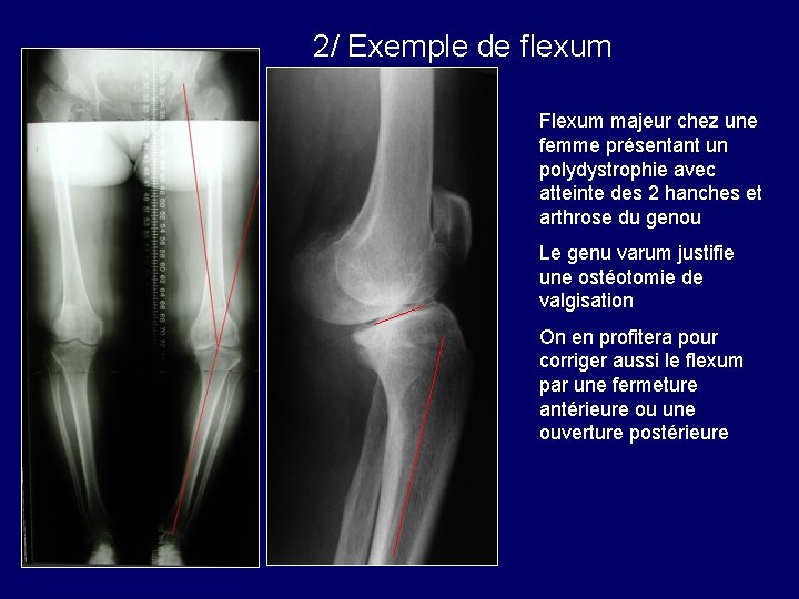 2/ Exemple de flexum Flexum majeur chez une femme présentant un polydystrophie avec atteinte 2/ Exemple de flexum Flexum majeur chez une femme présentant un polydystrophie avec atteinte