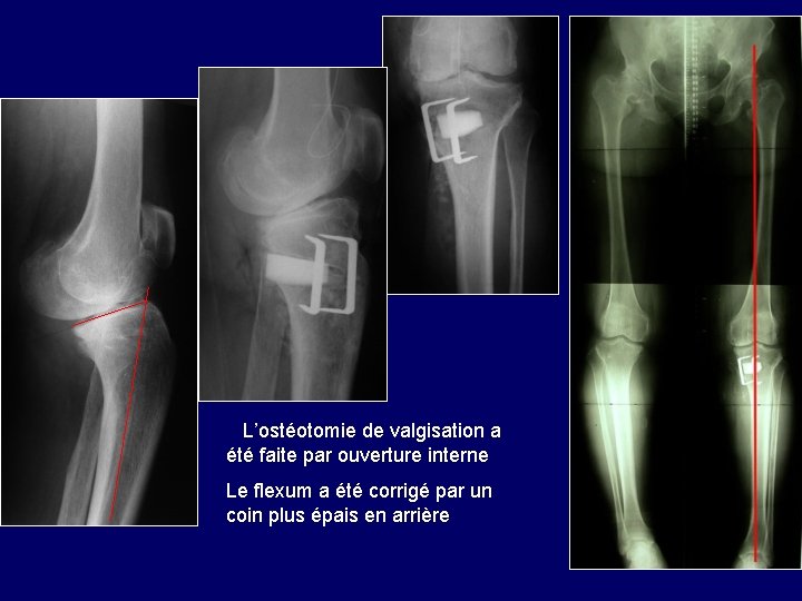 L’ostéotomie de valgisation a été faite par ouverture interne Le flexum a été L’ostéotomie de valgisation a été faite par ouverture interne Le flexum a été