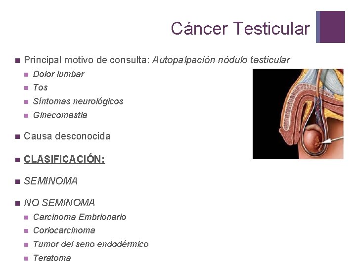 Cáncer Testicular n Principal motivo de consulta: Autopalpación nódulo testicular n Dolor lumbar n