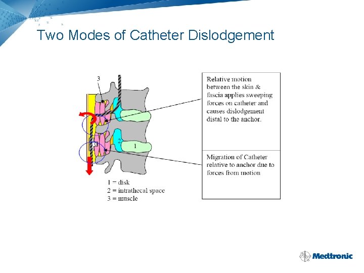 Two Modes of Catheter Dislodgement 