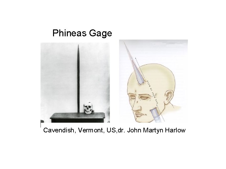 Phineas Gage Cavendish, Vermont, US, dr. John Martyn Harlow 