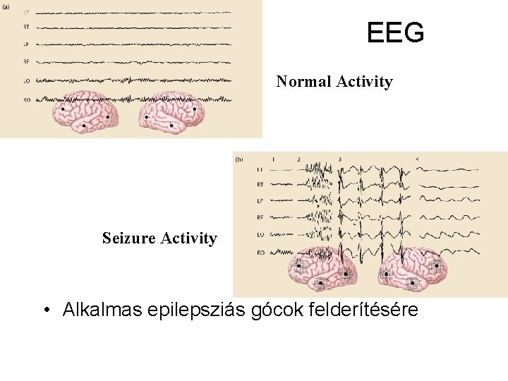EEG Normal Activity Seizure Activity • Alkalmas epilepsziás gócok felderítésére 