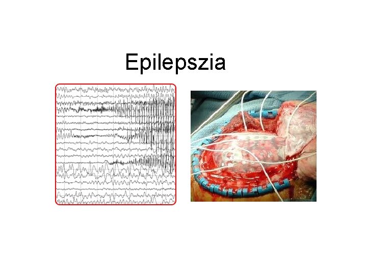 Epilepszia 