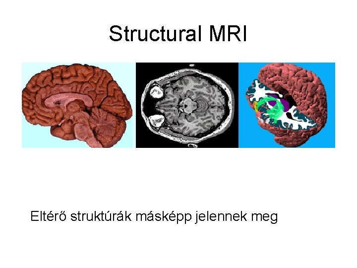 Structural MRI Eltérő struktúrák másképp jelennek meg 