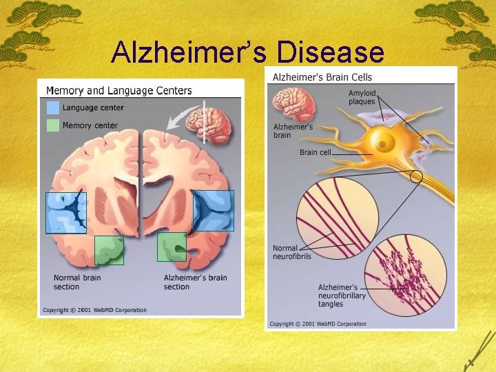 Alzheimer’s Disease Alzheimer’s Disease