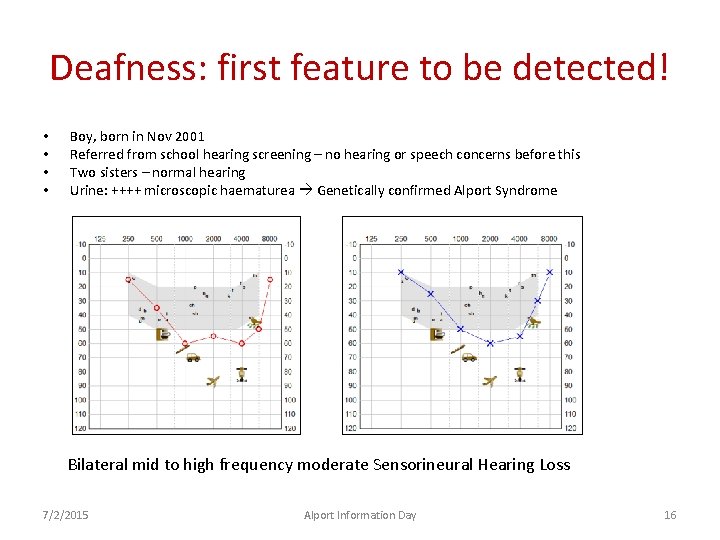 Deafness: first feature to be detected! • • Boy, born in Nov 2001 Referred