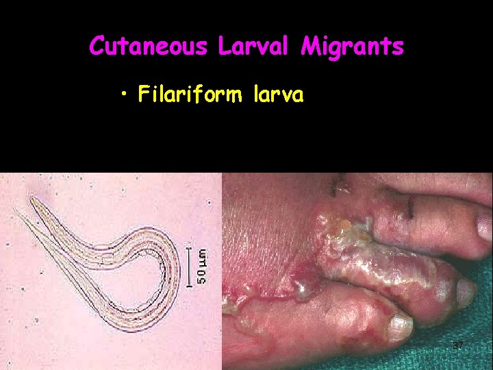 Cutaneous Larval Migrants • Filariform larva 37 