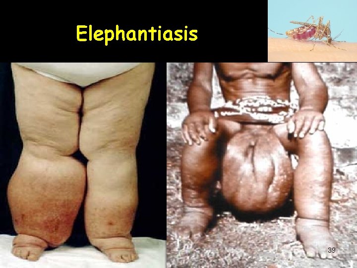 Elephantiasis 39 