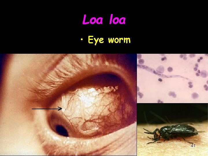 Loa loa • Eye worm 41 