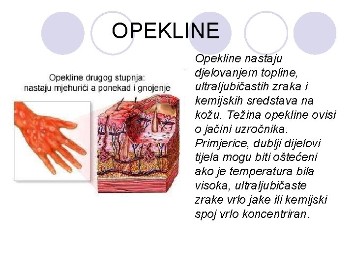 OPEKLINE Opekline nastaju djelovanjem topline, ultraljubičastih zraka i kemijskih sredstava na kožu. Težina opekline