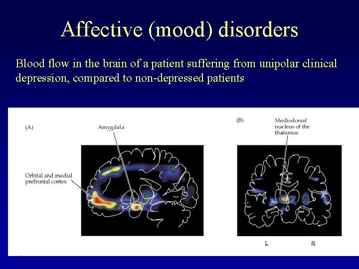 Affective (mood) disorders Blood flow in the brain of a patient suffering from unipolar