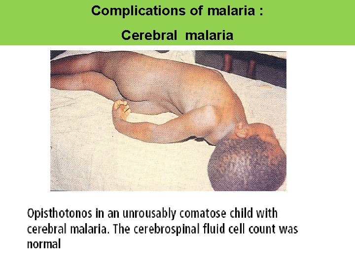 Complications of malaria : Cerebral malaria 