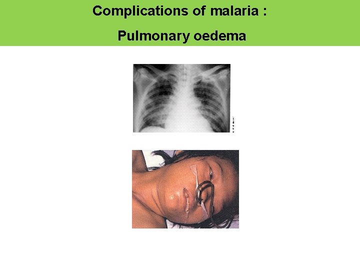 Complications of malaria : Pulmonary oedema 