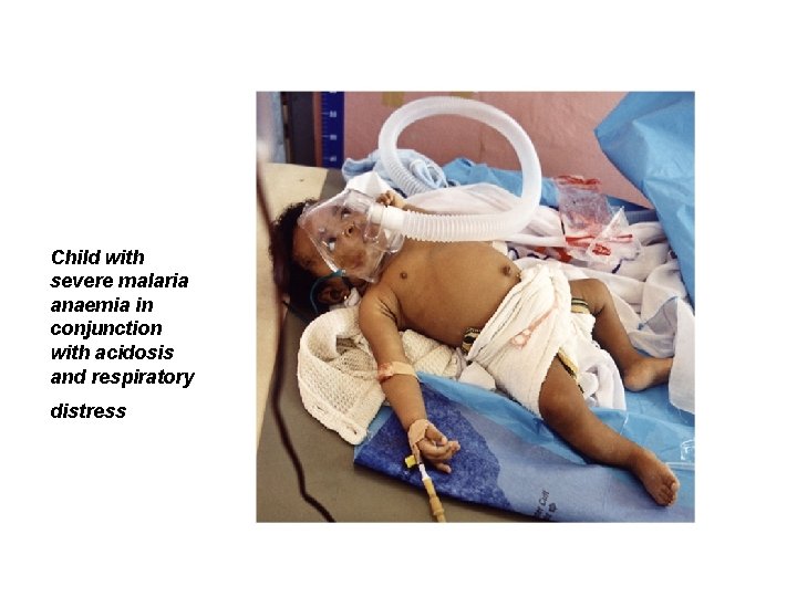 Child with severe malaria anaemia in conjunction with acidosis and respiratory distress 